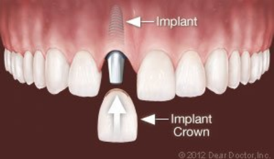 Dental Implant photo