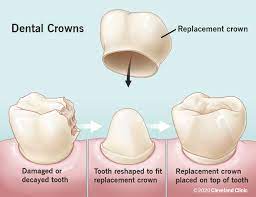 Same day Dental Crowns | Dentist In Lexington, KY | TLC Dentistry
